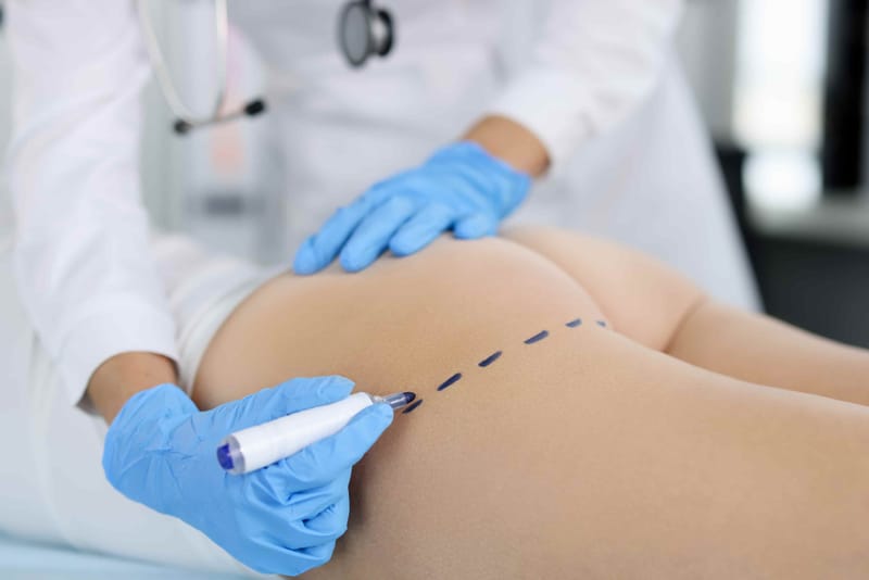 Why Quality Care Matters in Buttock Augmentation Surgery