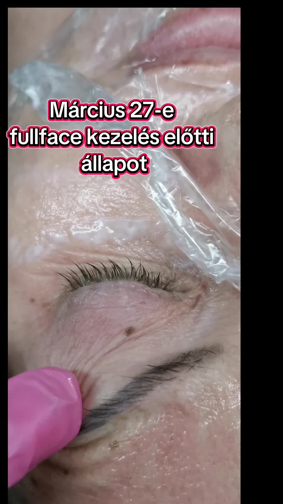 1 Teljes arc és egy szemhéj kezelés eredménye a felső szemhéjon