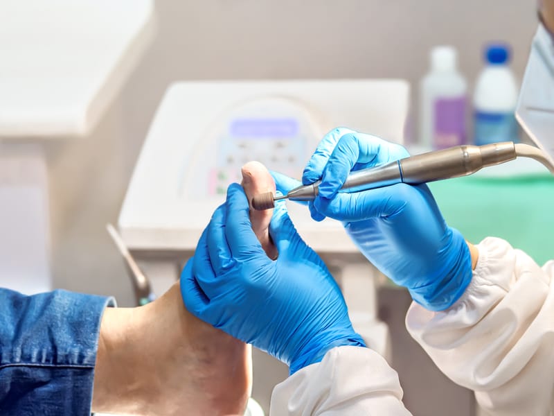 Odciski, Modzele, Kurzajki