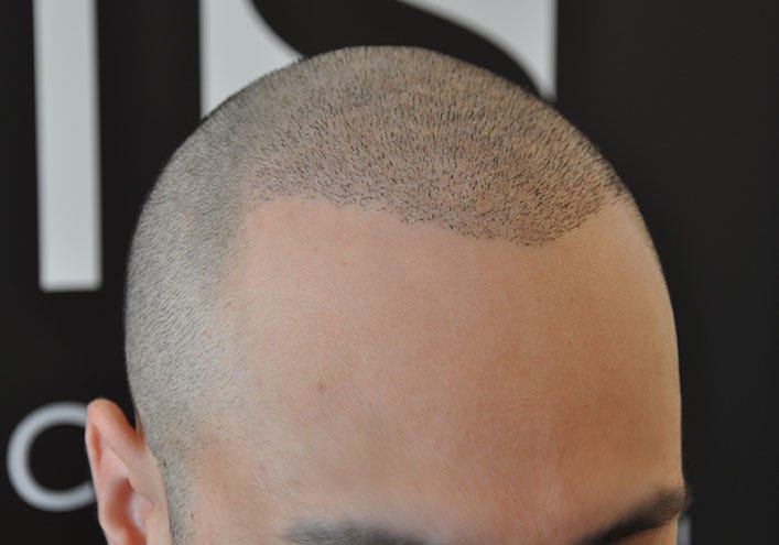 Is PRP Hair Therapy in Dubai More Expensive Than in Saudi Arabia?