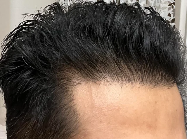 How does PRP Therapy work for hair regrowth in Islamabad Pakistan ?